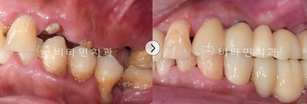 충치로 인해 치아가 부식된 부위 발치 후 브릿지 식립