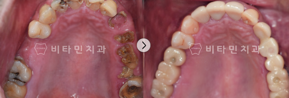 충치로 인해 치아가 부식된 부위 발치 후 브릿지 식립