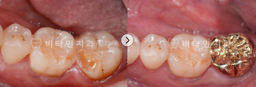 충치가 심한 부위를 치료 후 골드크라운 진행