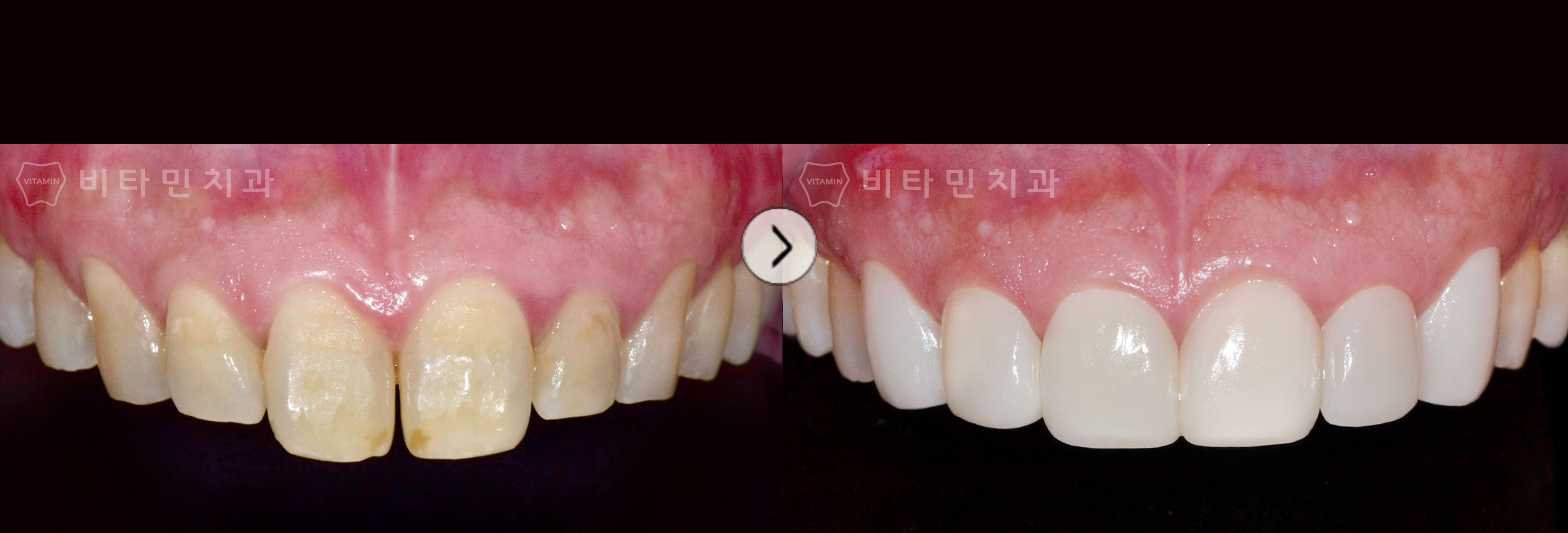 긴 앞니와 전체적으로 누렇게 착색된 치아를 심미적으로 건강하게 개선