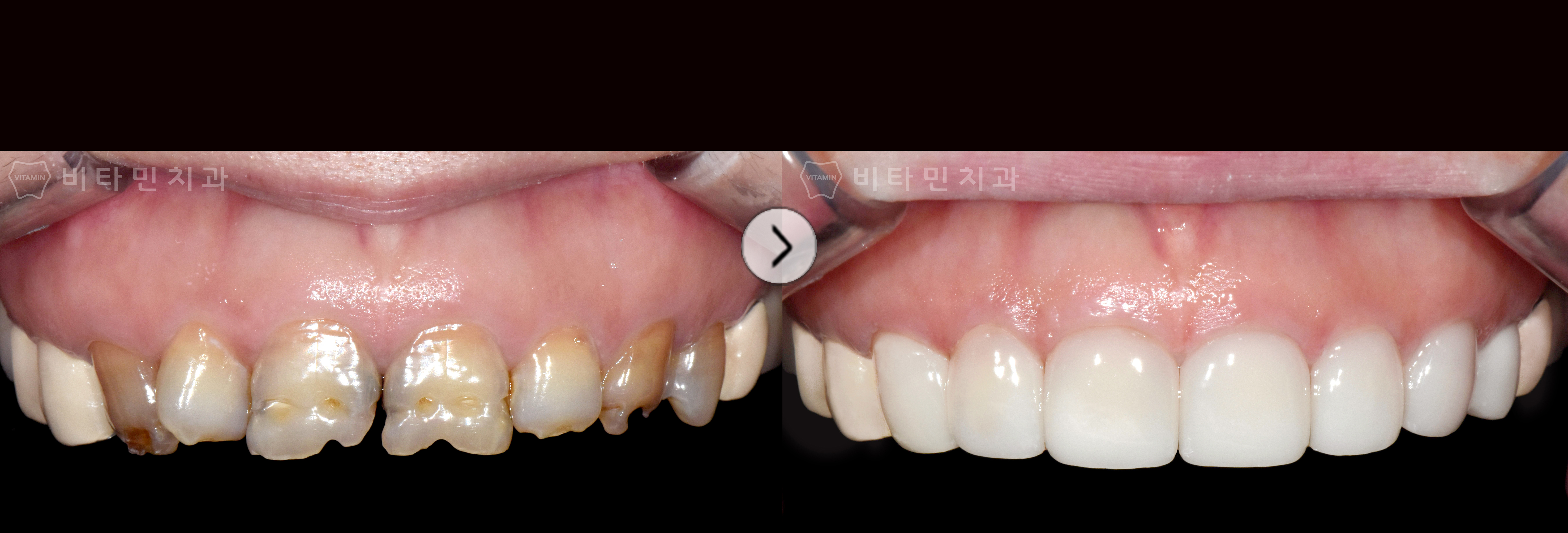 전체적으로 심한 손상과 착색된 치아를 가지런하고 예쁜 치아로 개선