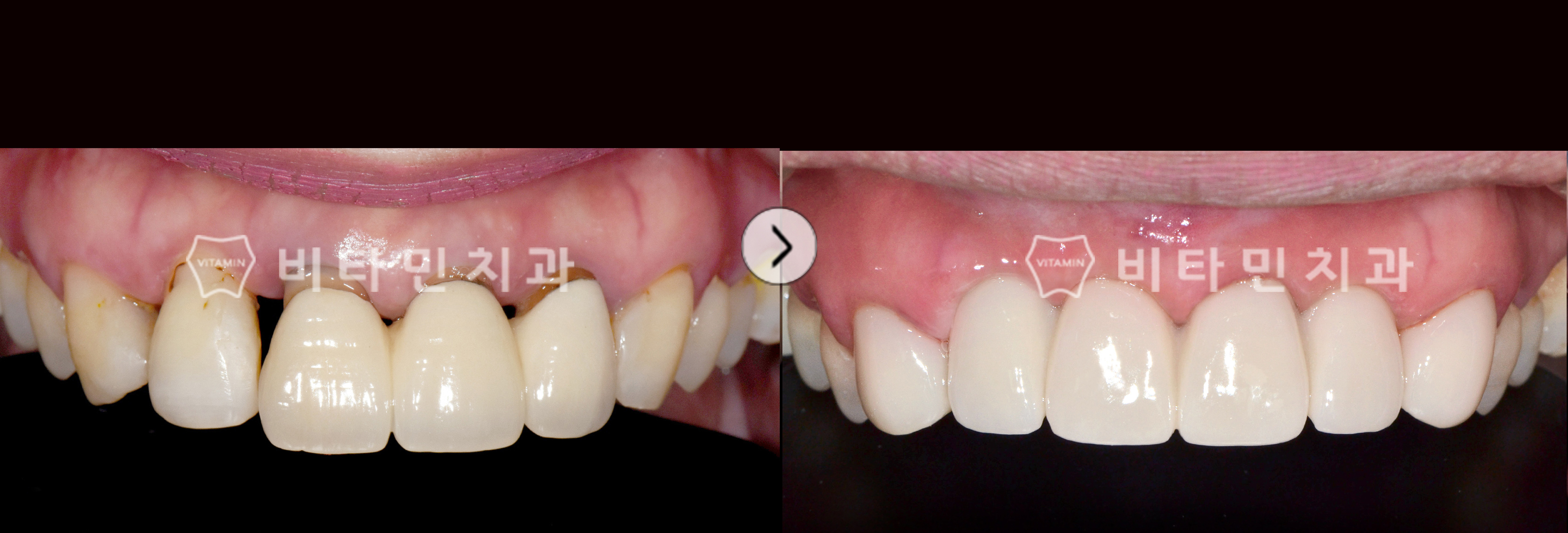 오래된 보철물과 벌어진 잇몸을 비타코팅과 브릿지로 아름답게 개선