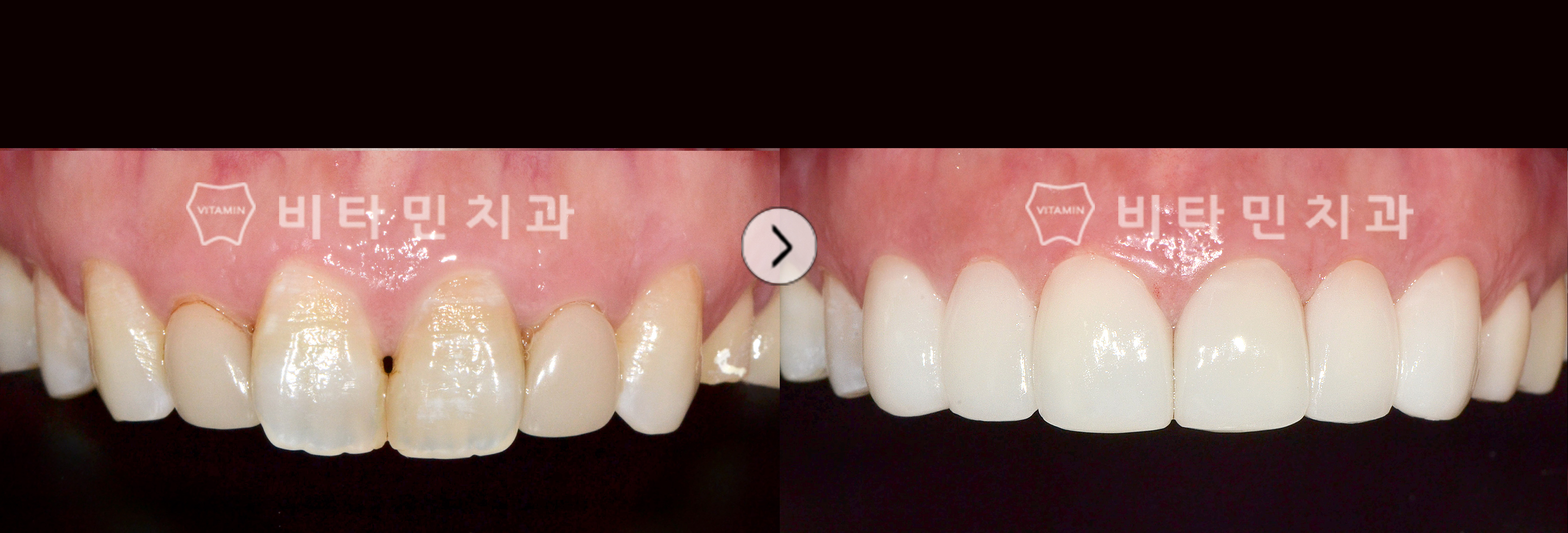 큰 앞니, 고르지 못한 잇몸라인 비타코팅으로 예쁜 스마일라인과 치아로 복원