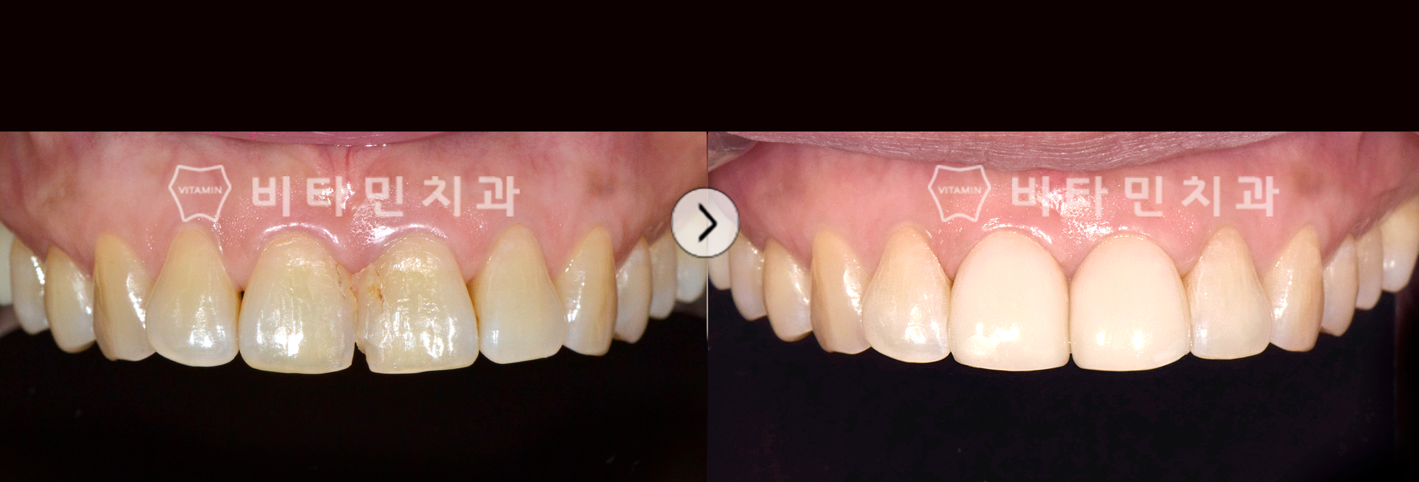 오래된 레진과 착색된 치아를 앞니 비타코팅으로 전체적인 치아 심미 개선