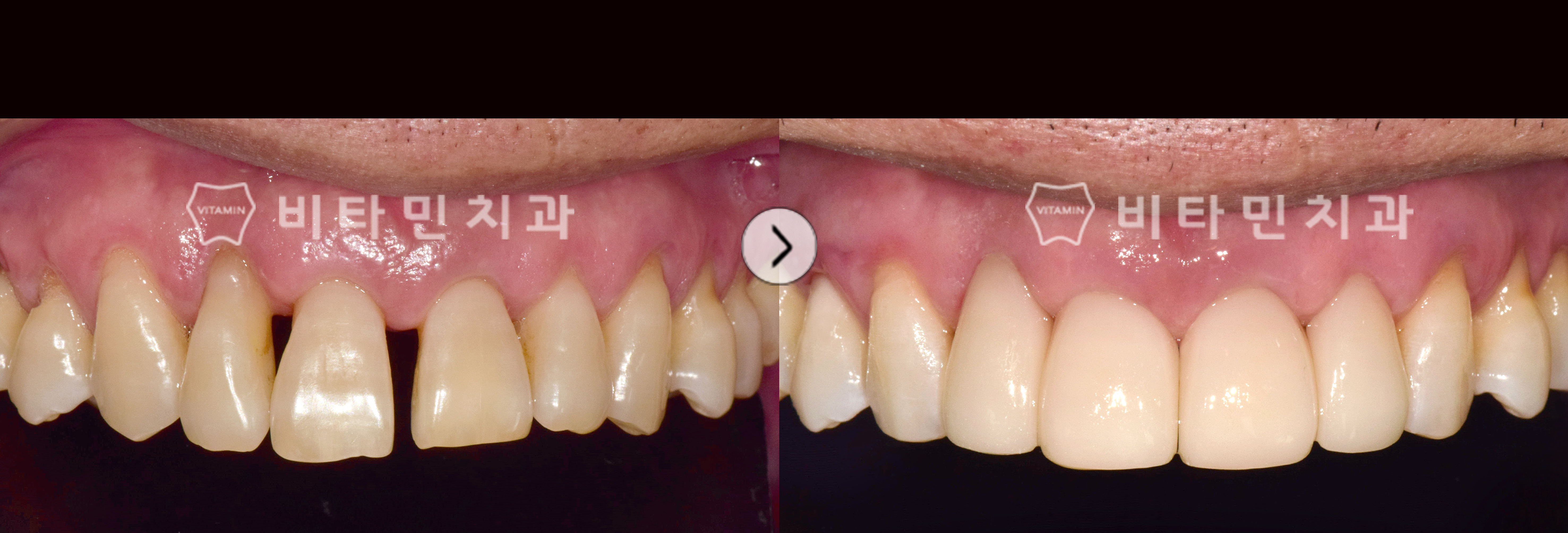 벌어진 치열 및 고르지 못한 잇몸라인 비타코팅으로 볼륨감있는 치아로 개선