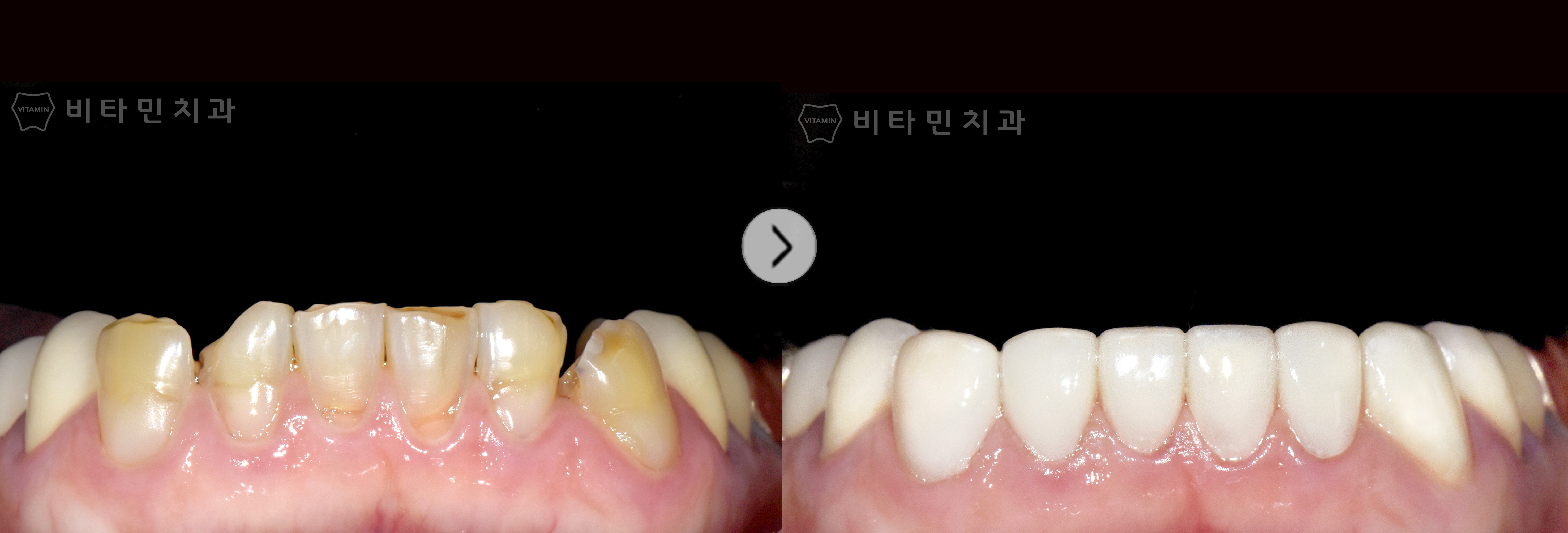 전체적으로 심한 손상 및 마모된 치아 자연스러운 잇몸라인과 치아로 복원