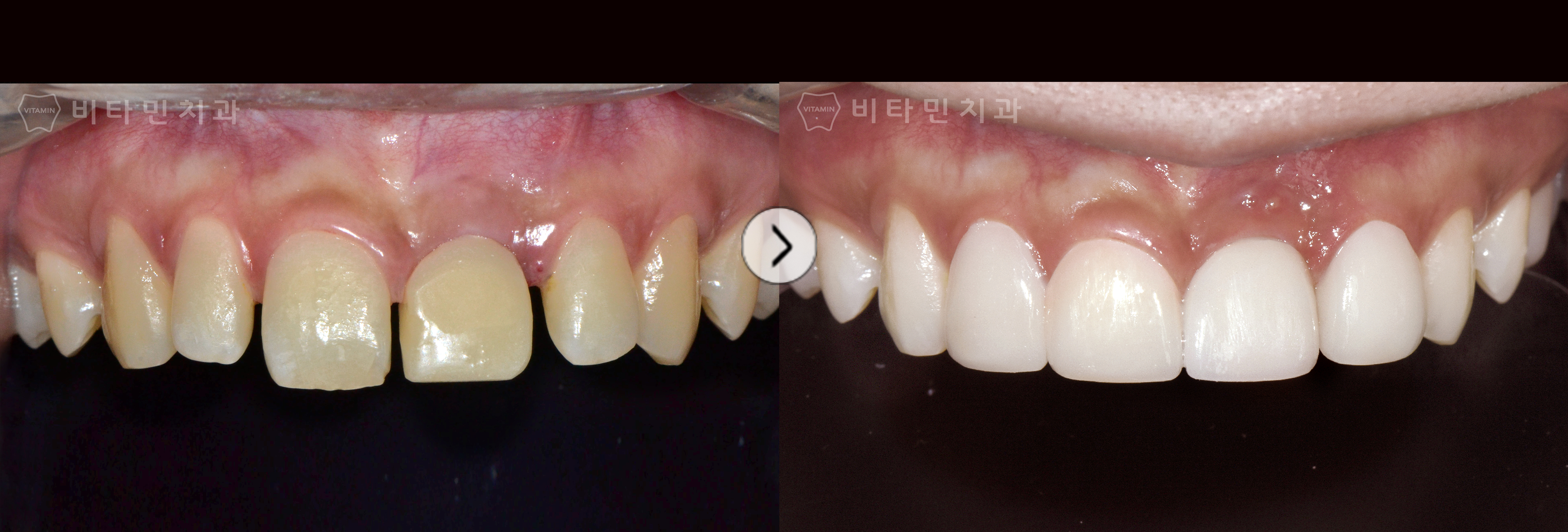 넓은 사이 공간, 착색된 치아를 고른 치열과 자연스러운 치아로 개선
