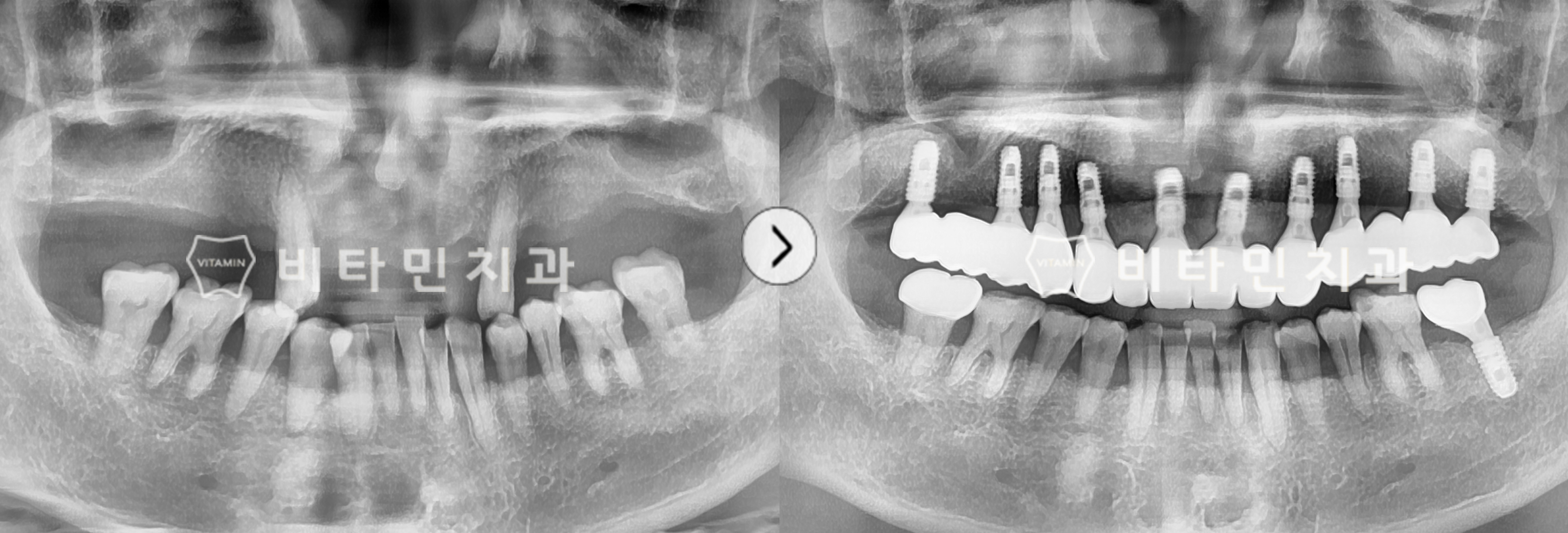 부분틀니 불편해 전체 임플란트 식립으로 치아의 기능성과 심미성 회복