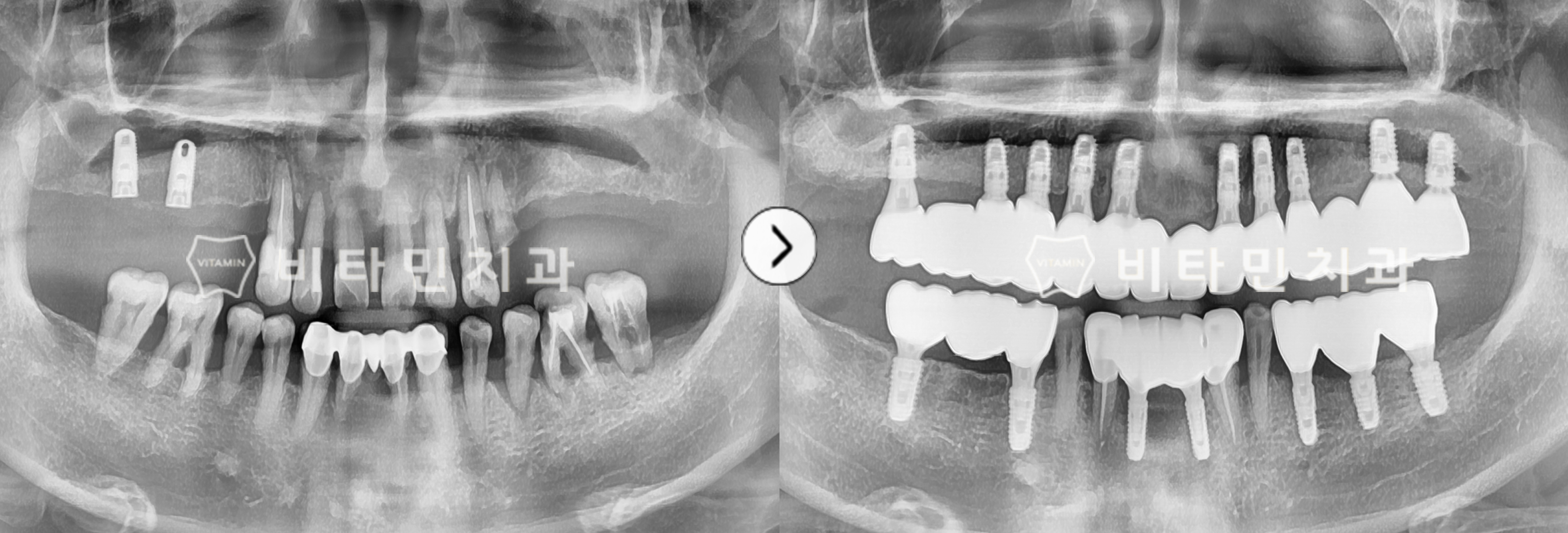 타 치과 임플란트 제거 후 전체 임플란트 식립으로 모든 치아 복원