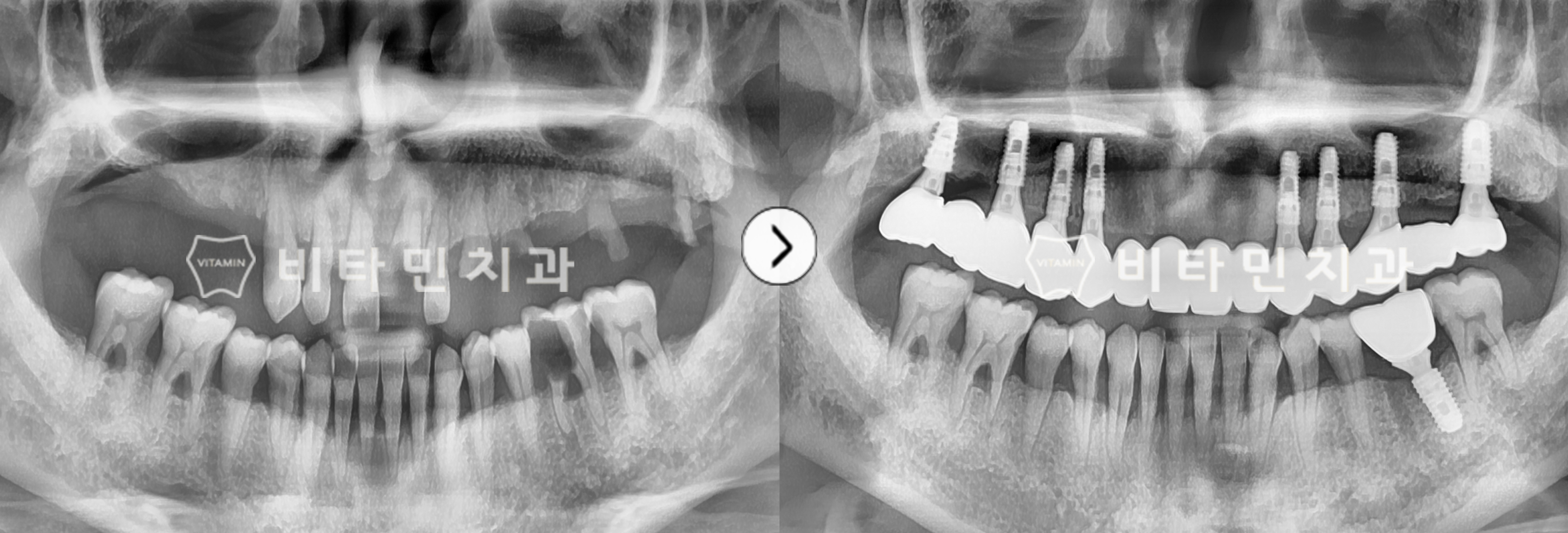 상태가 좋지 않은 치아 다수 발치 후 전체 임플란트 식립