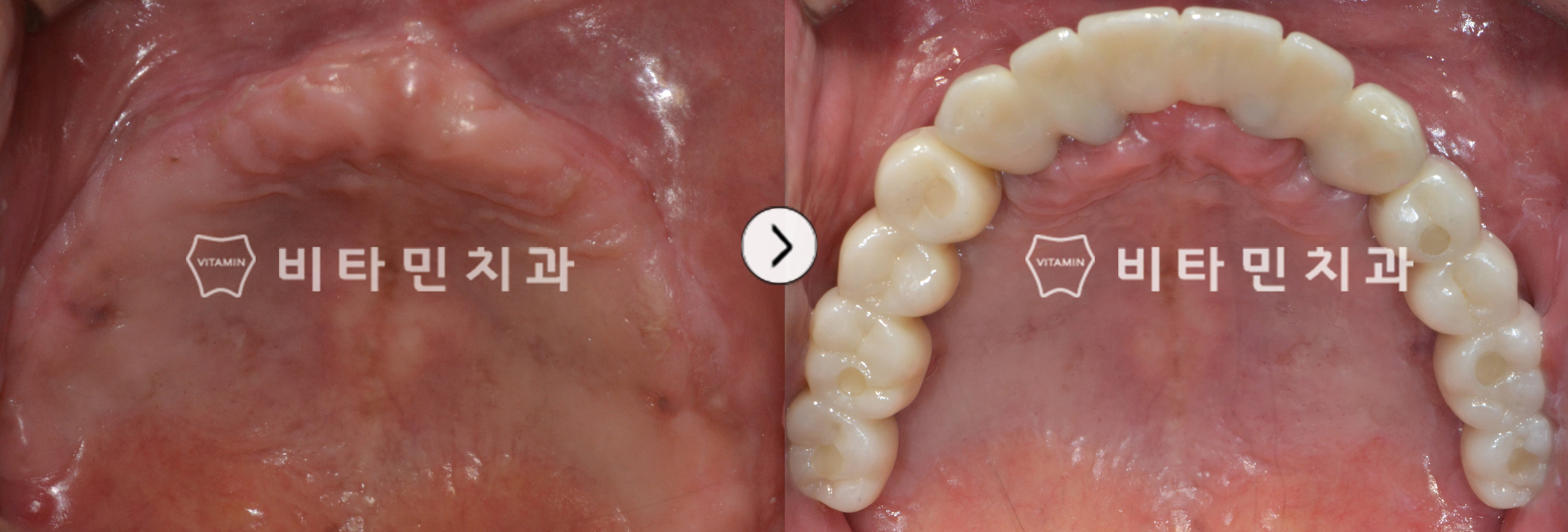 상악 틀니 사용하였으나 불편함으로 인해 전체 임플란트 식립