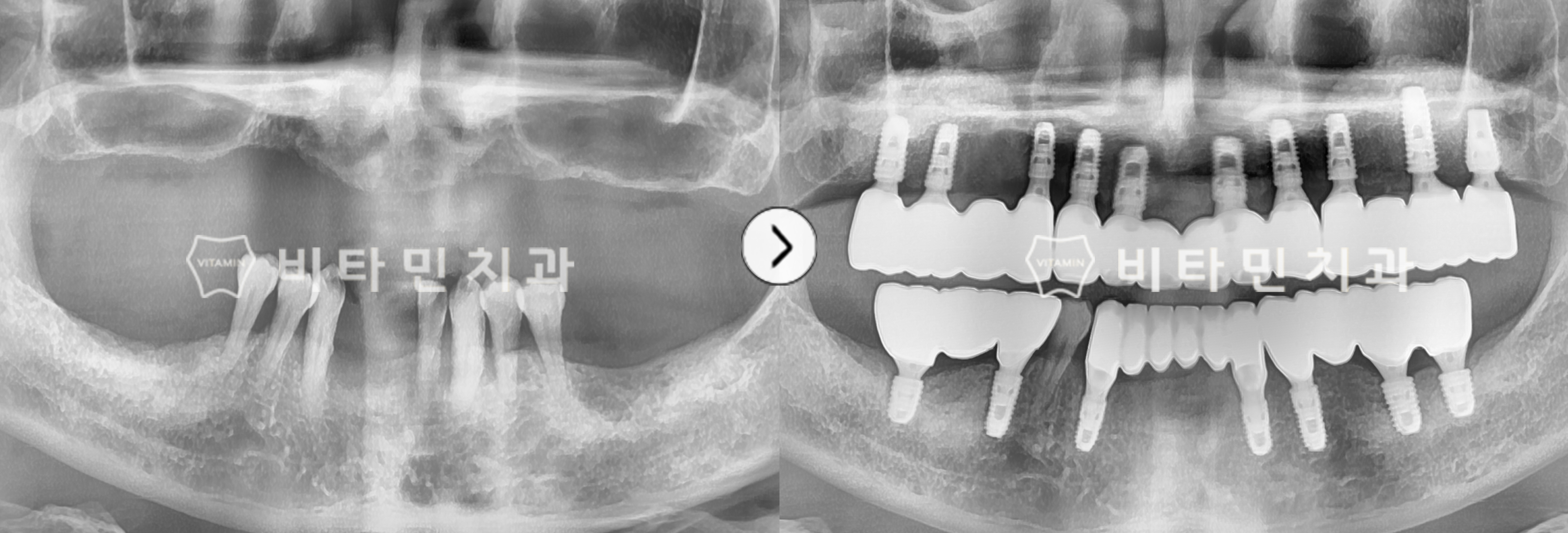 상/하악 틀니 사용하였으나 불편함으로 전체 임플란트 식립