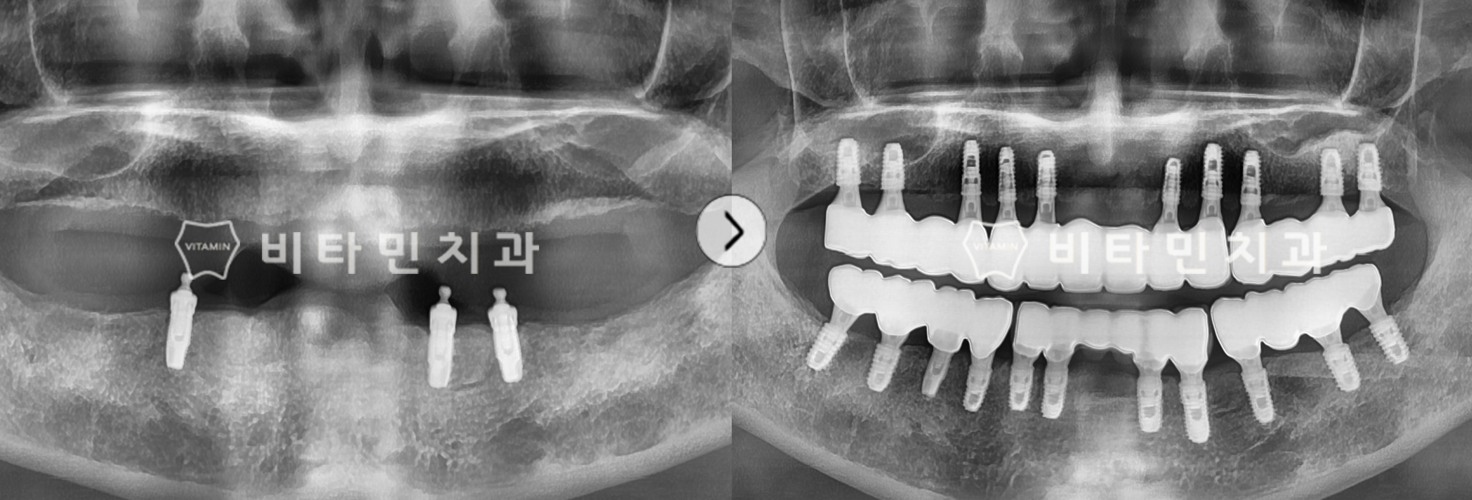 틀니 불편함으로 상하악 전체임플란트 통해 치아 기능성, 심미성 회복