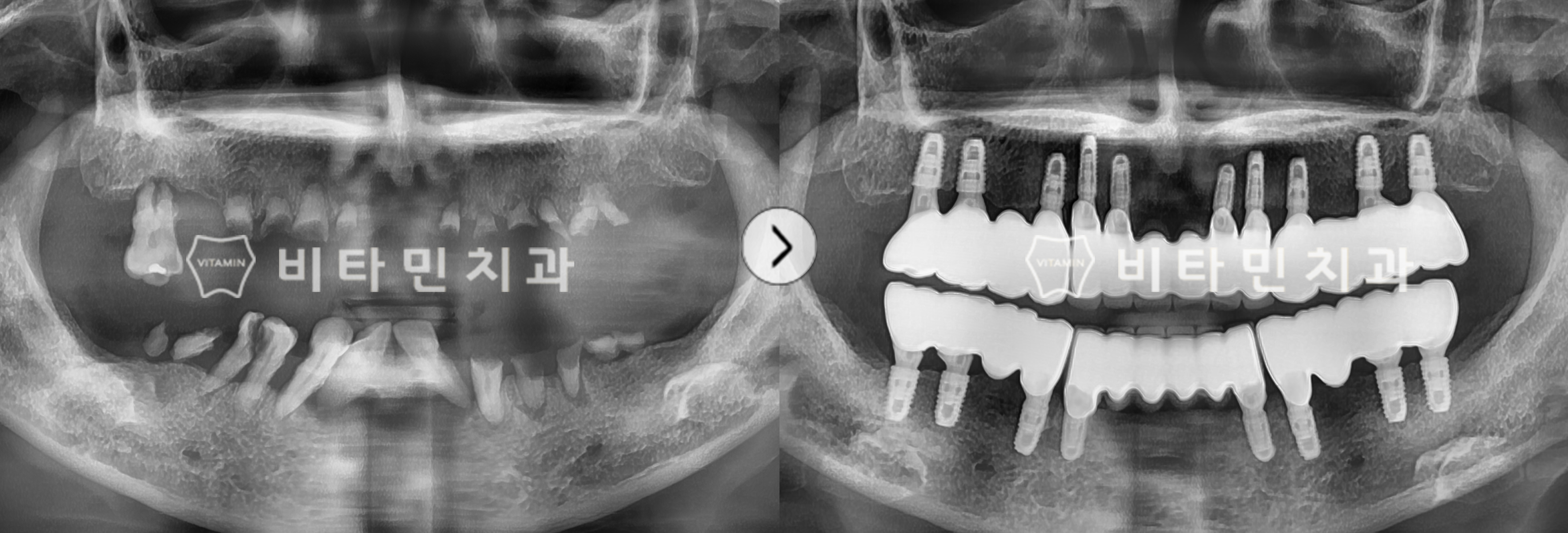 기능을 상실한 모든 치아를 발치 후 전체 임플란트 식립