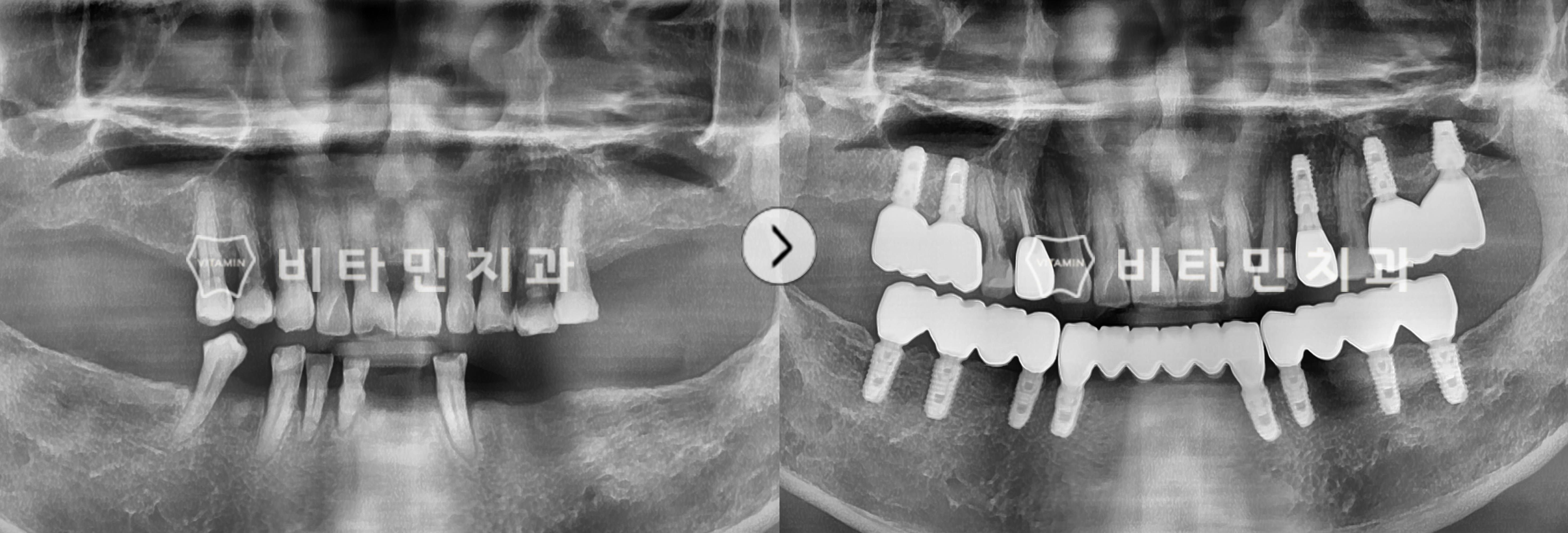 부분틀니 후 상태가 좋지않은 치아 발치하여 하악 전체임플란트 식립