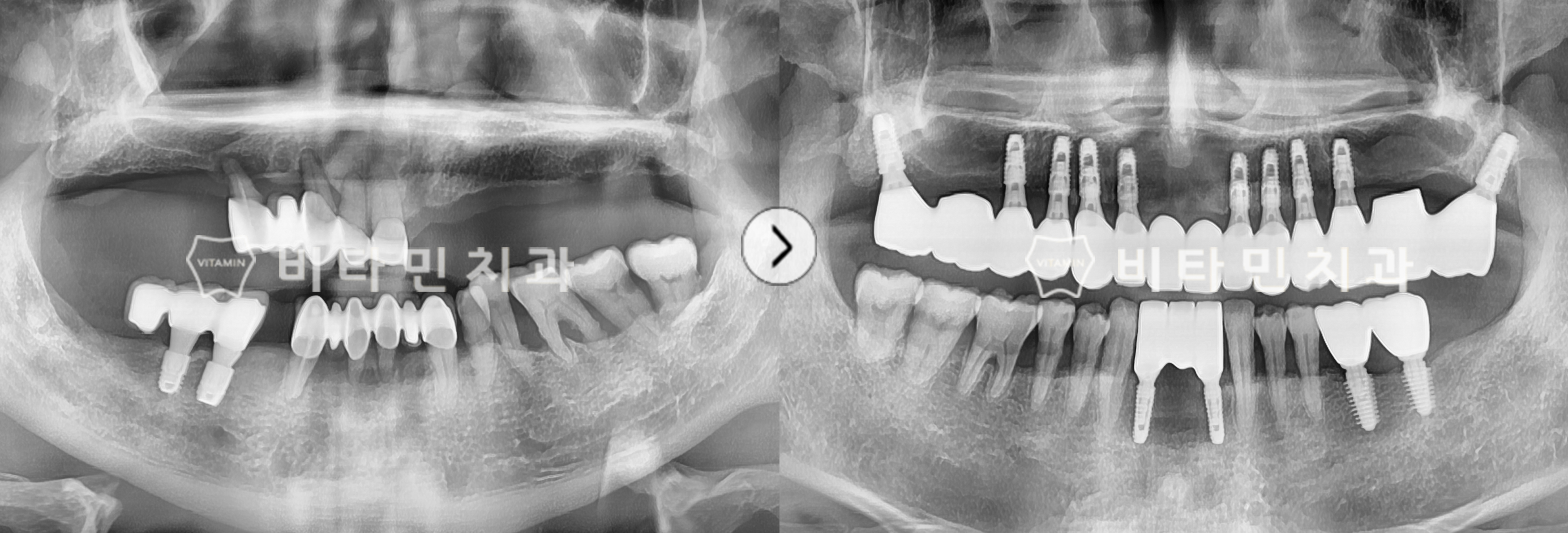 부분틀니 사용하였으나 불편하여 치아 발치 후 전체 임플란트 식립