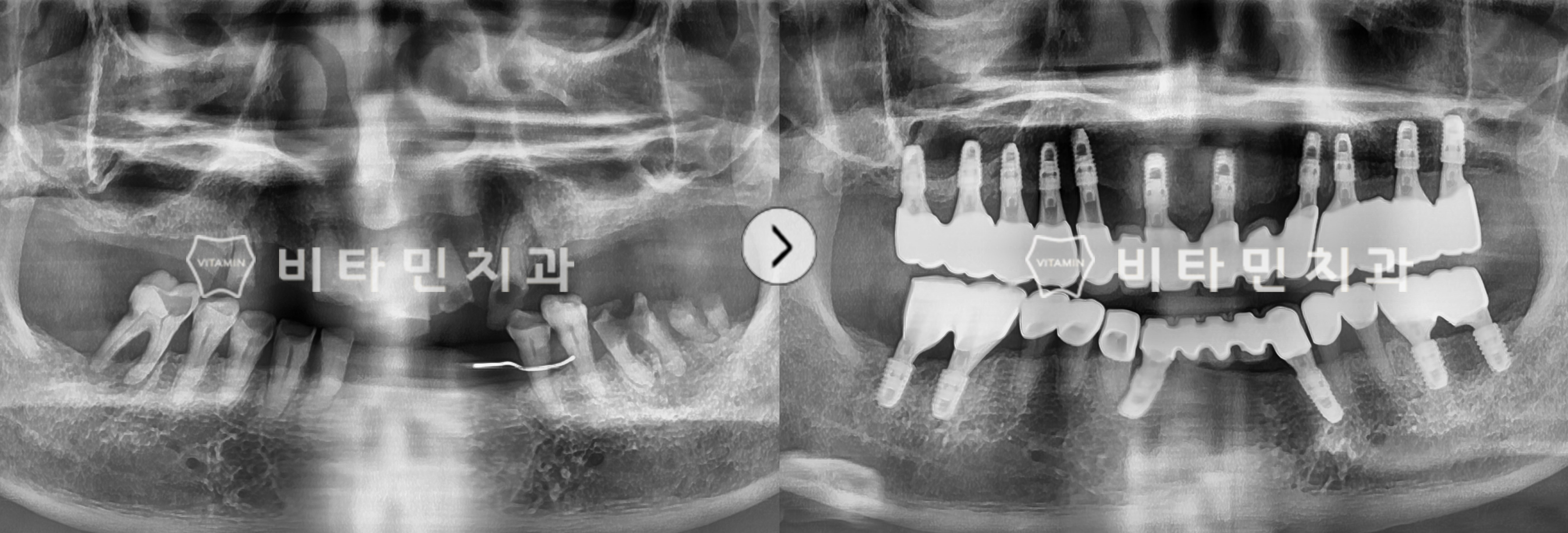 기능을 상실한 치아 발치 후 상악 전체 임플란트 식립
