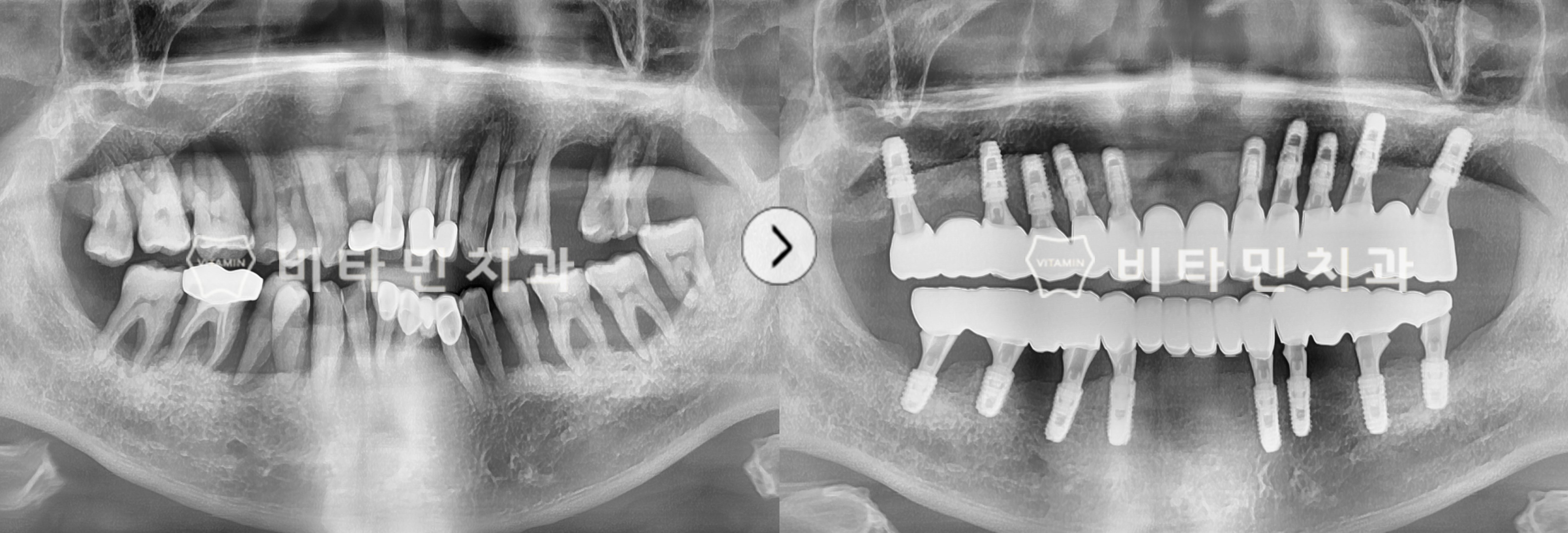기능을 상실한 치아를 모두 발치 후 전악 임플란트 식립