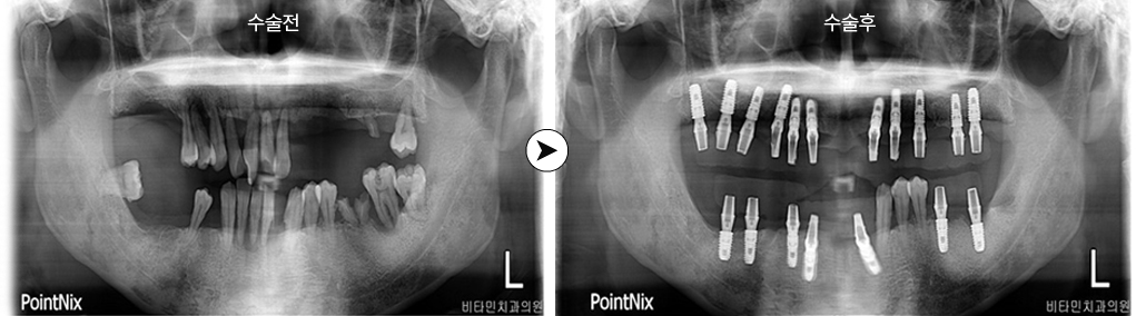 수술전후