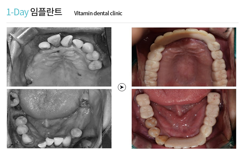 전후사진