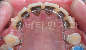 부천 설측 교정