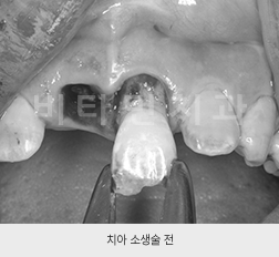 치아 소생술