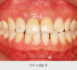 광명 치아소생술